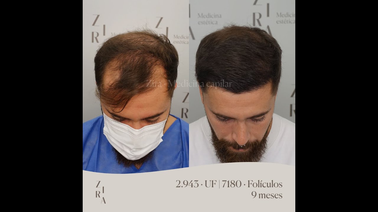 Trasplante capilar : ¿Cómo el tipo de pelo y el diseño de la línea determinan el Resultado?
