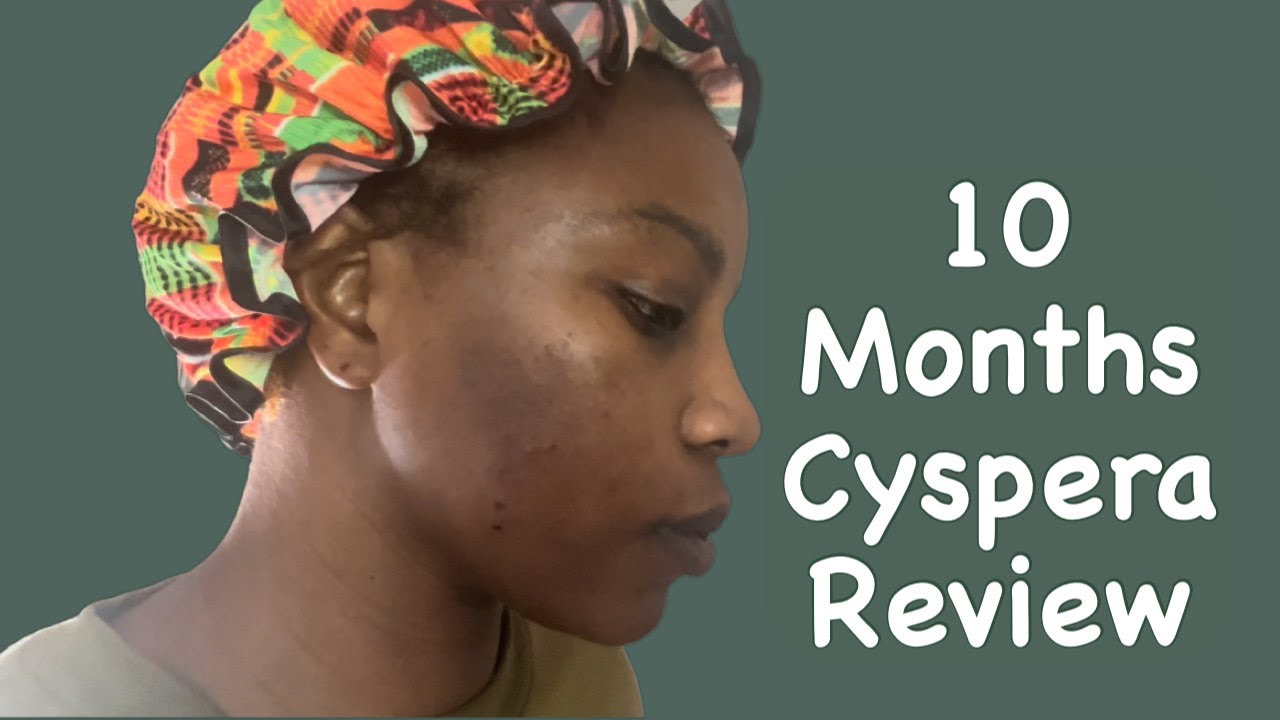 Cyspera Before And After 10 Months Review Answering Questions
