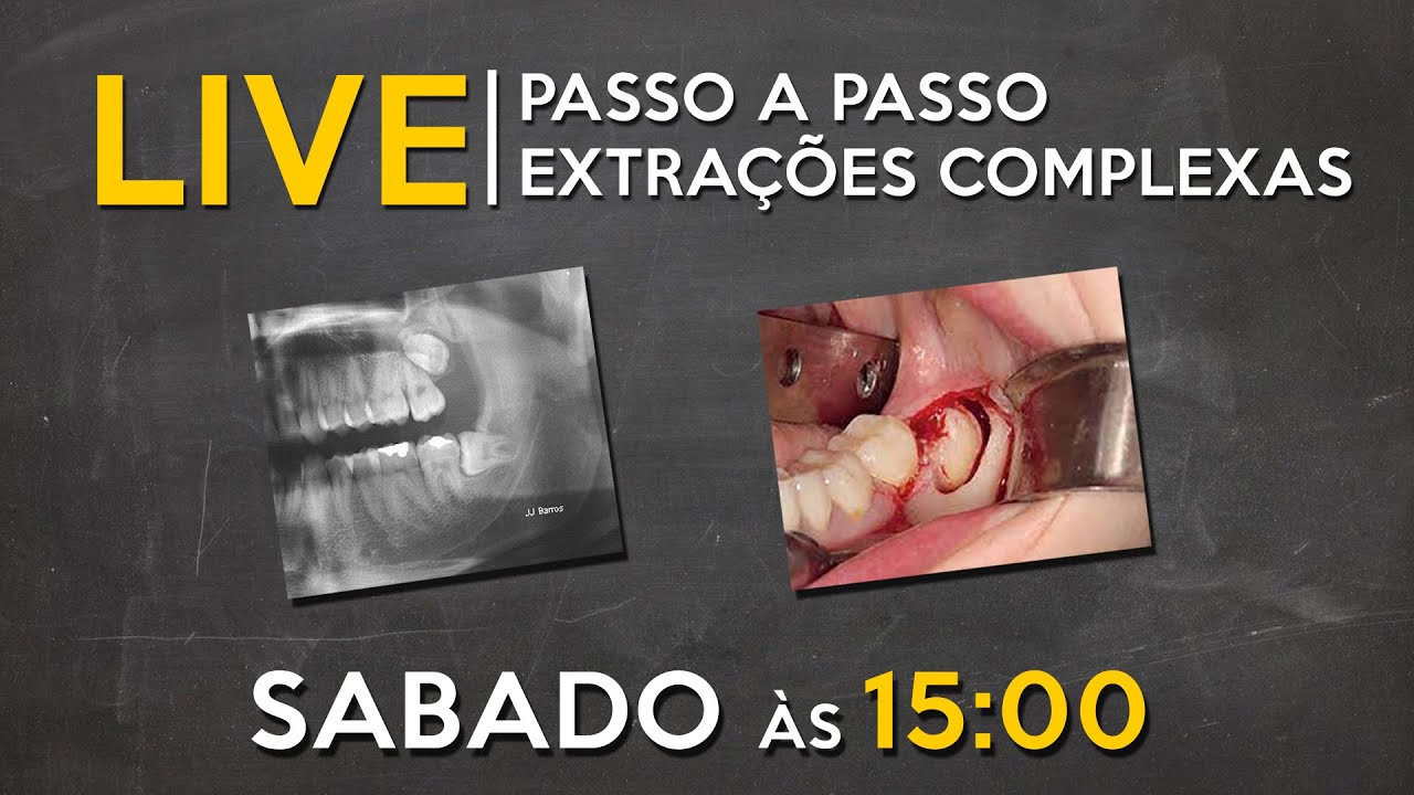 LIVE #025 - Passo a passo de extrações complexas