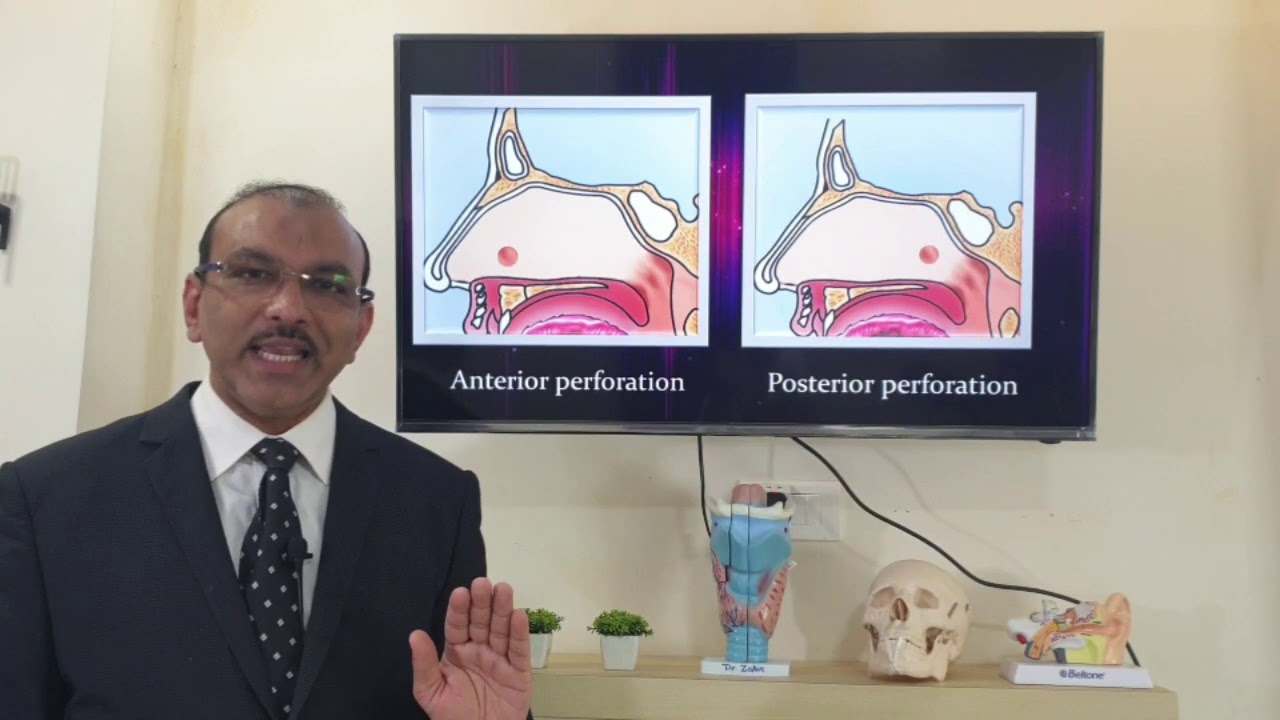 Septal perforation (English) Patient teaching programme