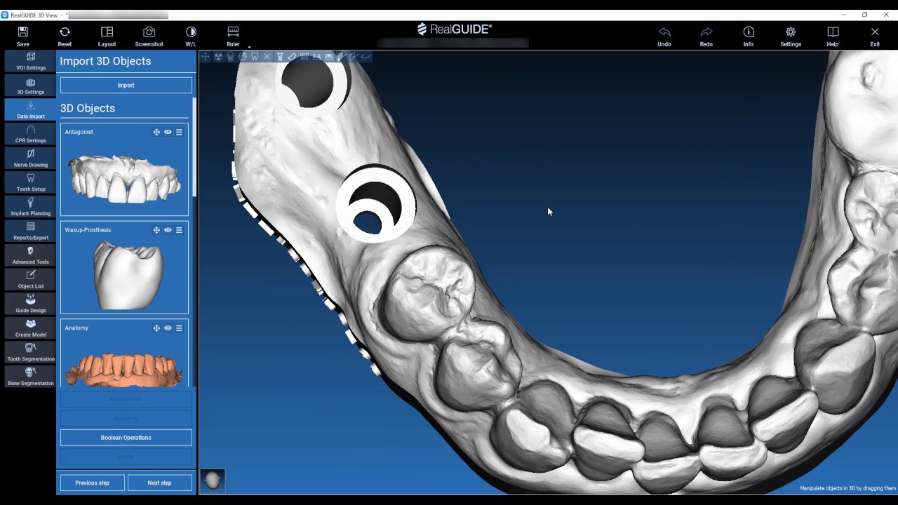 STL file processing and model set up with 3DIEMME RealGUIDE 5.0