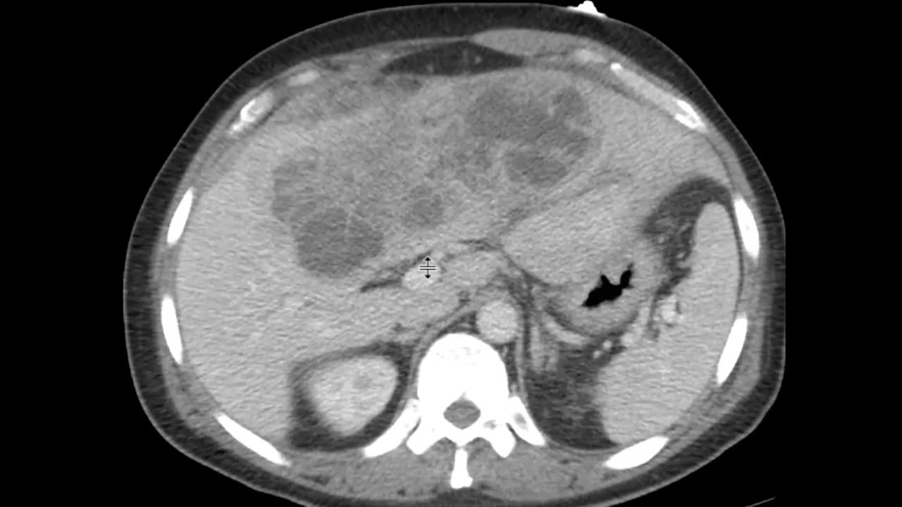 Hepatic Abscess With Multiloculated Appearance