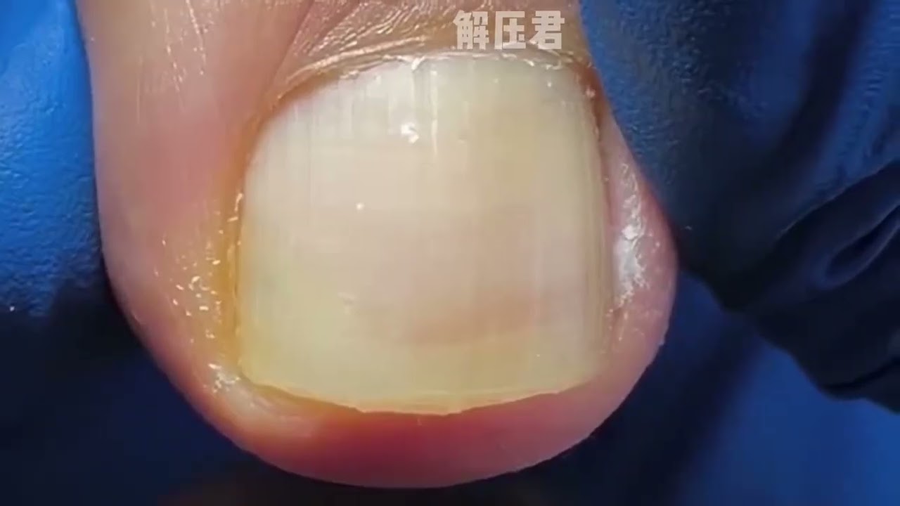 这个脚趾甲真的长#解压 #修脚 #强迫症