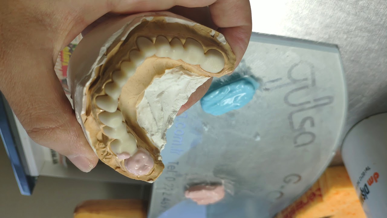 🦷 DİŞ PROTEZ BÖLÜMÜ (ALT ÜST ZİRKONYUM YÜKLEMESİ) #PART 1