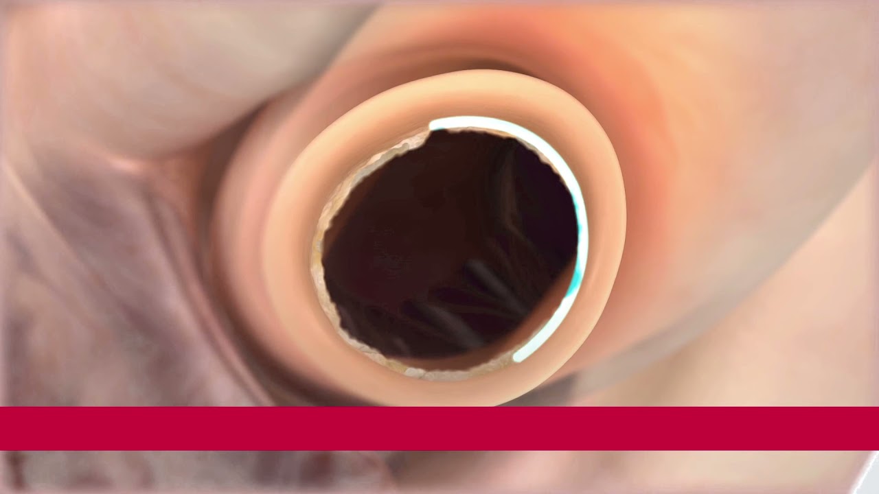 A Perceval Plus IMPLANT video