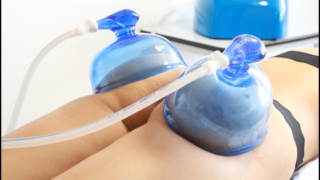 Vacumterapia en Gl&uacute;teos