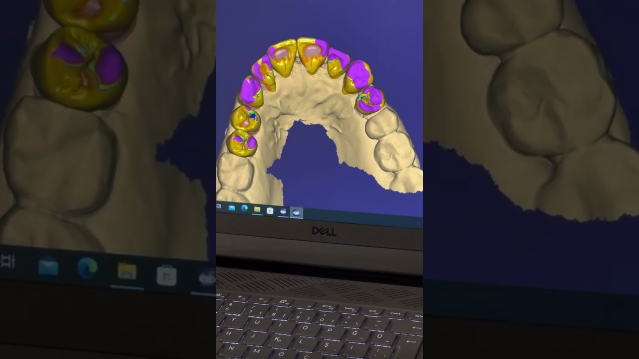 Exocad programında zirkonyum diş tasarımı✅ Zirconium tooth design in Exocad program