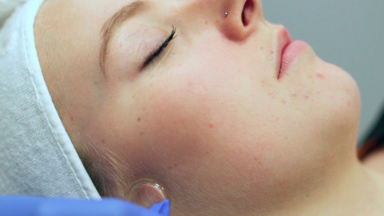 Delta Laser HydraFacial