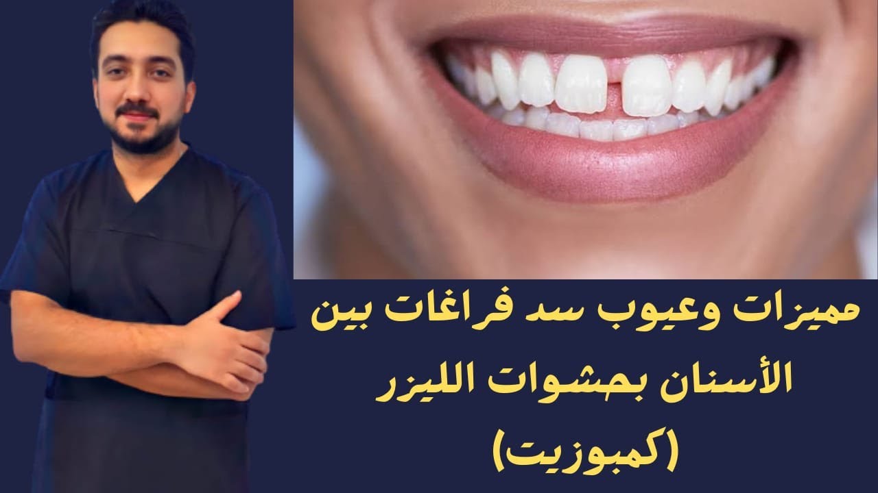 مميزات وعيوب سد فراغات الأسنان بحشوات الليزر (كمبوزيت)