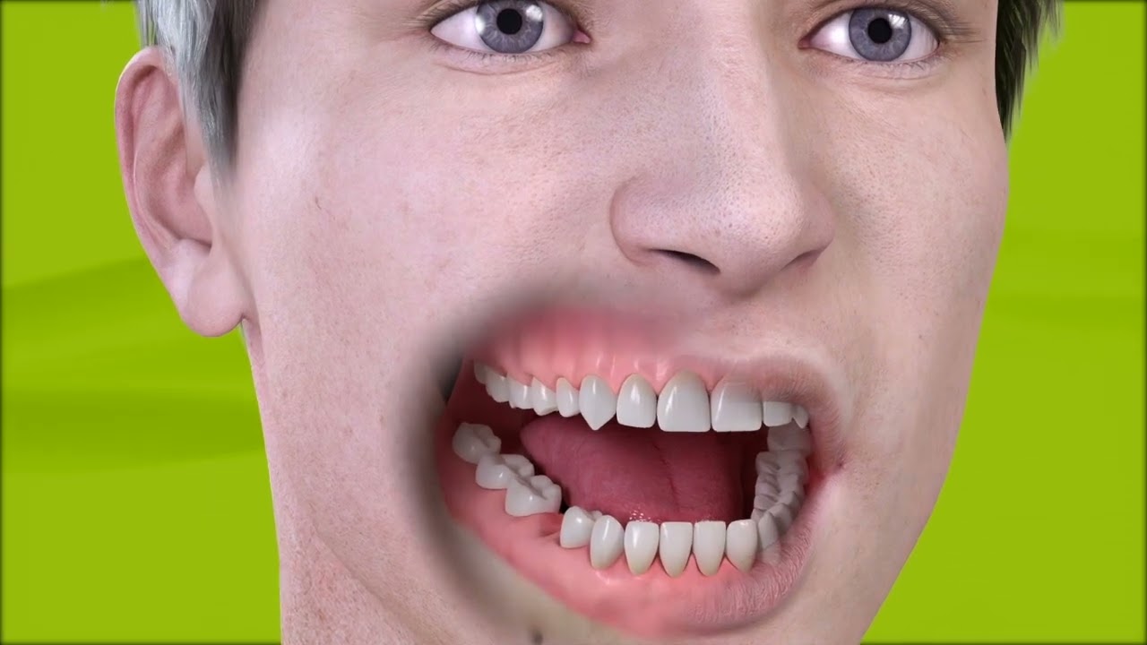 Trattamento dente singolo su impianto