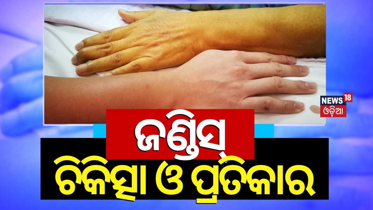 My Doctor: ଜଣ୍ଡିସ୍‌ର ଚିକିତ୍ସା ଓ ପ୍ରତିକାର |Symptoms And Treatment Of Jaundice | HealthCare |Odia News