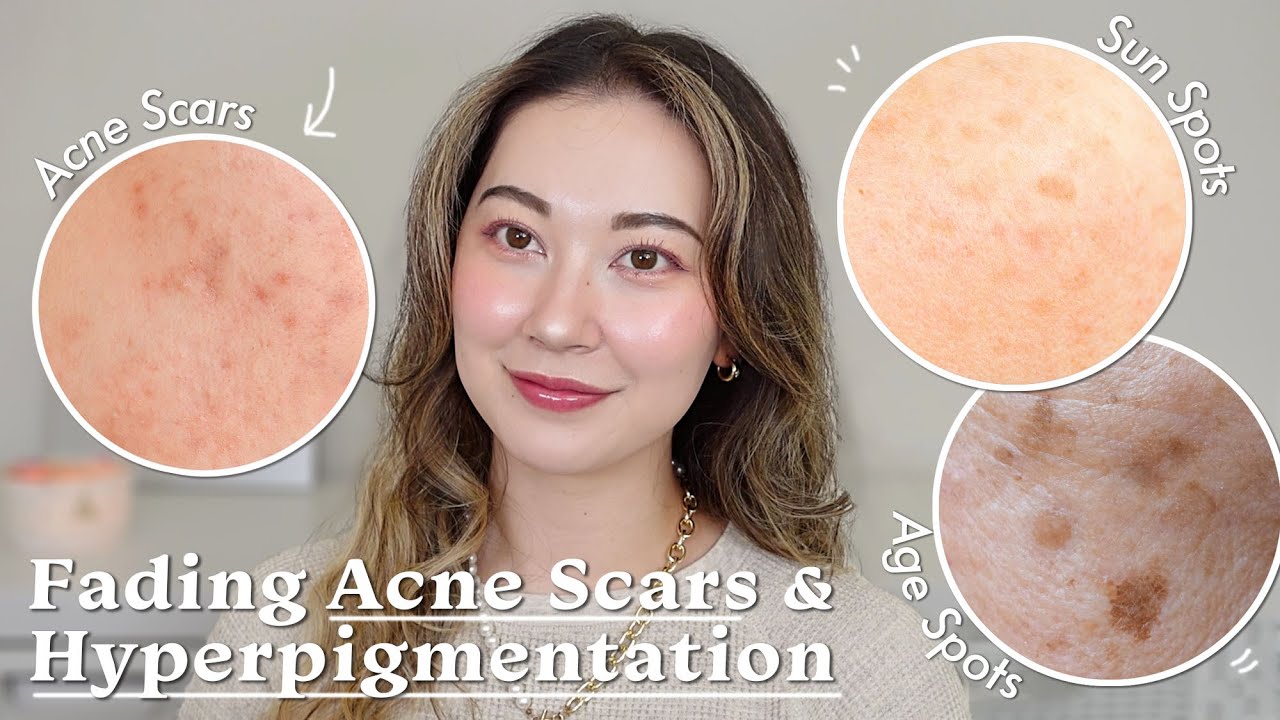 Fading Acne Scars & Hyperpigmentation | Vitamin C Dupes for Sensitive Skin ft. P.CALM