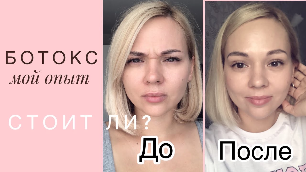 Первый ботокс в 35.  Мой опыт. Дневник наблюдения.