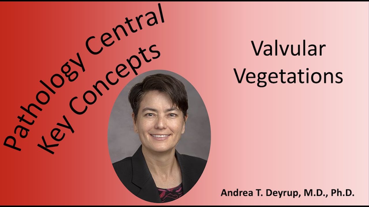 Medical School Pathology: Pathophysiology of Valvular Vegetations
