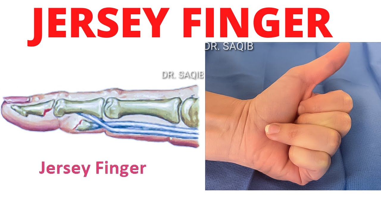 Jersey Finger | Flexor Tendon Injury | Everything You Need to Know