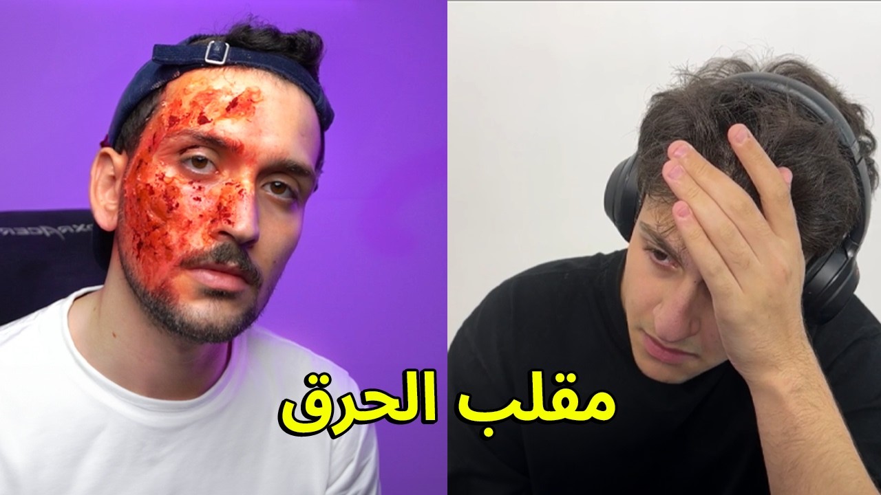 مقلب الحروق في اخوي عبسي شوفو شنو صار !!