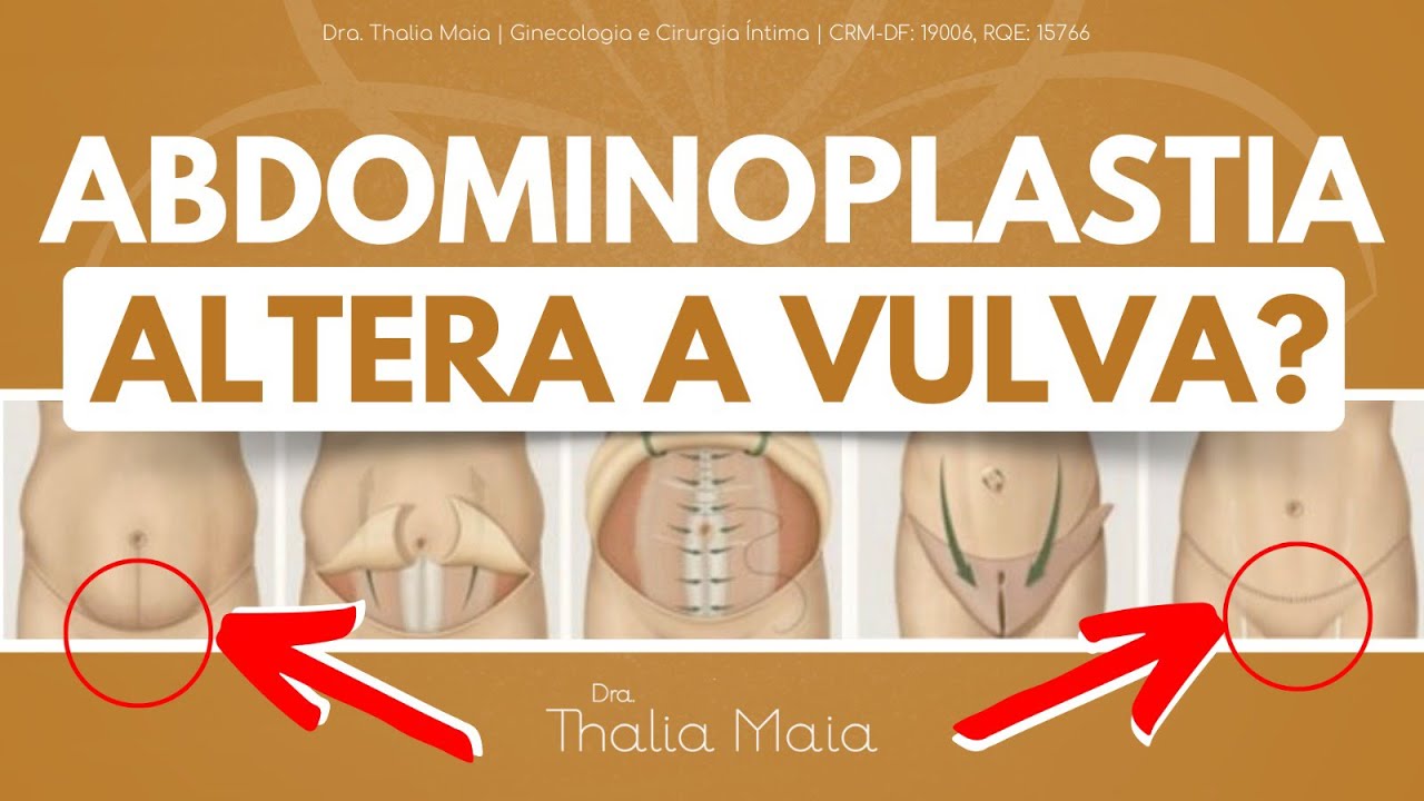 Impacto da Abdominoplastia na Região Íntima | Dra. Thalia Maia | Ginecologia e Cirurgia Íntima