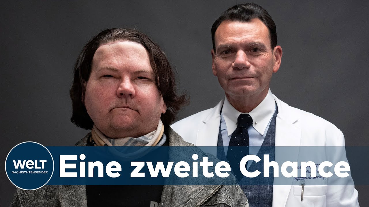 NEUES GESICHT und NEUE H&Auml;NDE: Die Transplantation erm&ouml;glicht Joe DiMeo eine 