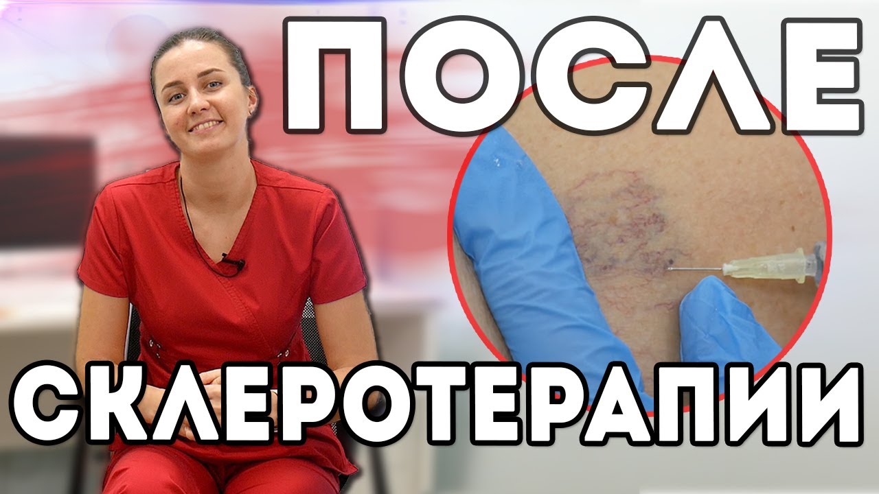Период восстановления после склеротерапии