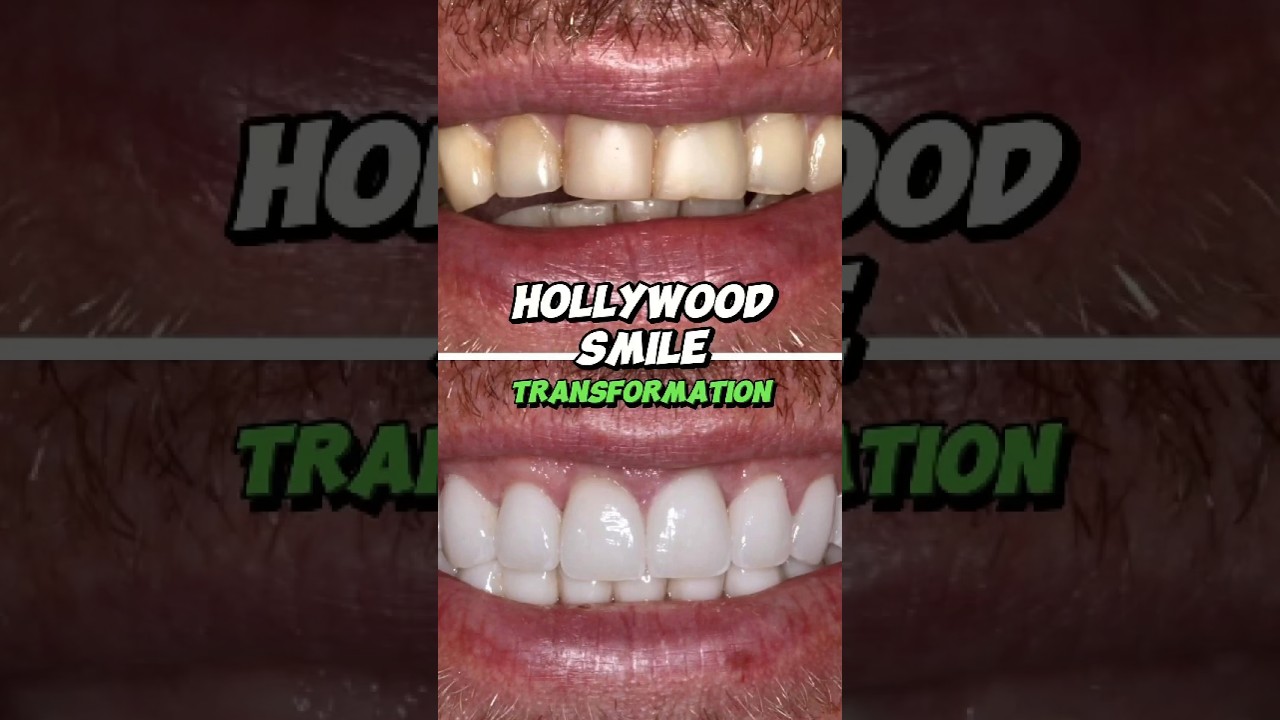 Hollywood Smile Makeover: Before and After