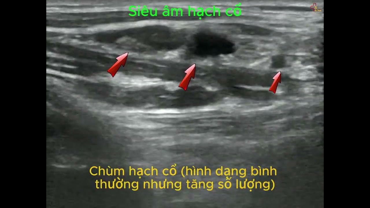 Siêu Âm Hạch Cổ: Dễ Làm Nhưng Chẩn Đoán Không Đơn Giản #Siêu_âm_mô_mềm #siêu_âm_hạch_cổ