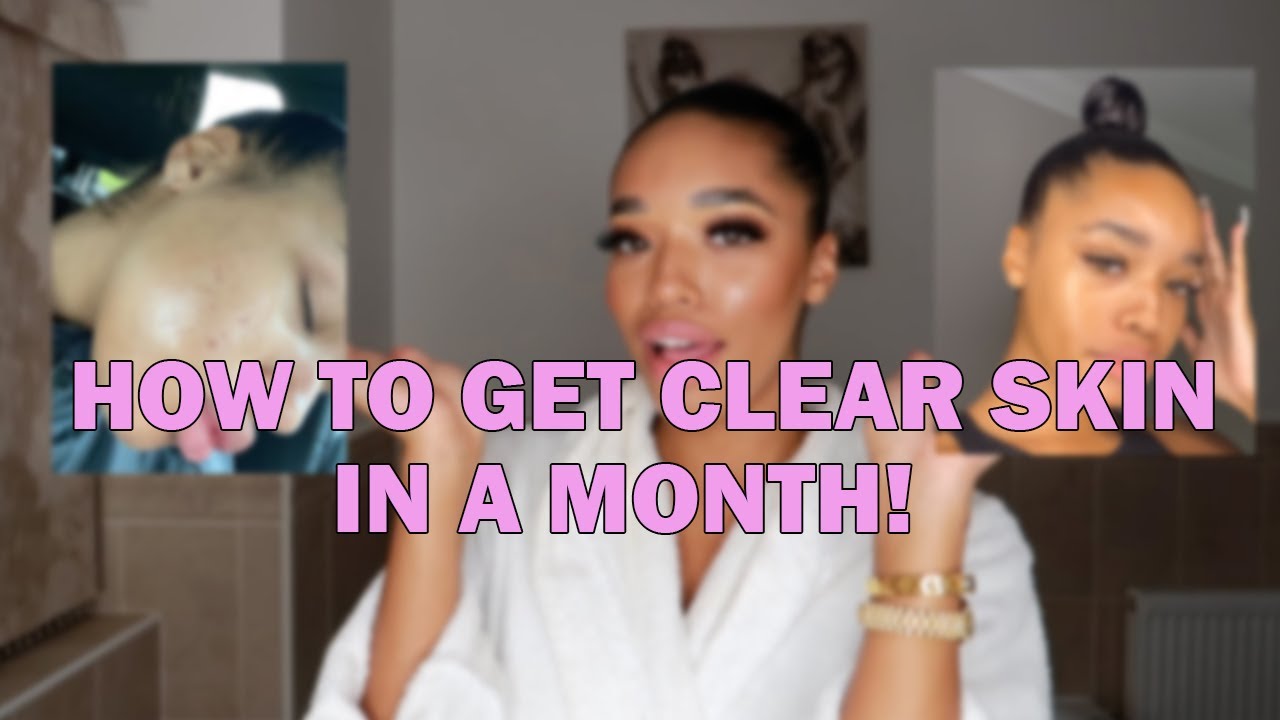 How To Get Clear Skin In A Month!