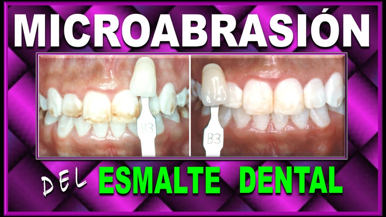 ¿Manchas en tus dientes? Mira este tratamiento sencillo