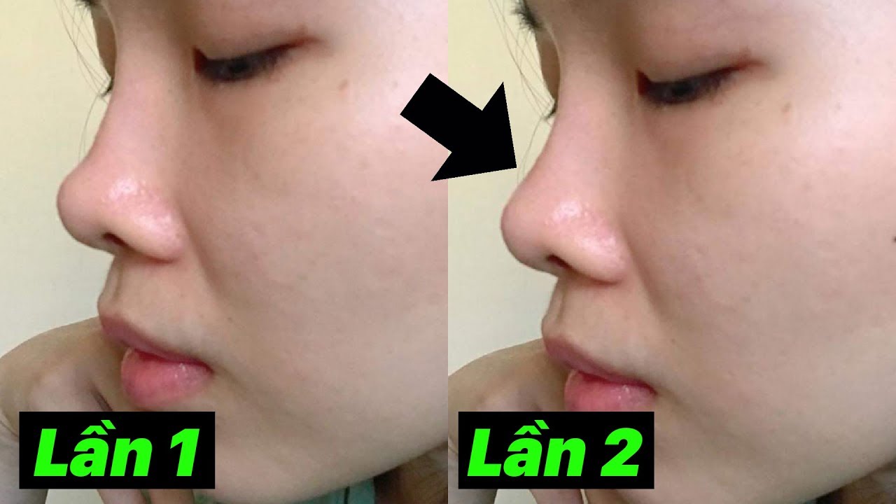 VÌ SAO RƯ NÂNG MŨI LẦN 2 🔥🔥🔥