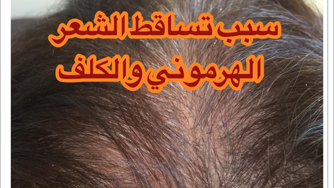 السبب الرئيسي لتساقط الشعر الهرموني والكلف