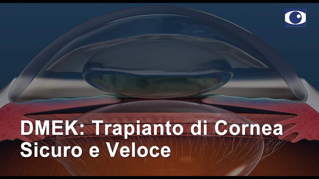 DMEK: Trapianto di Cornea Sicuro e Veloce