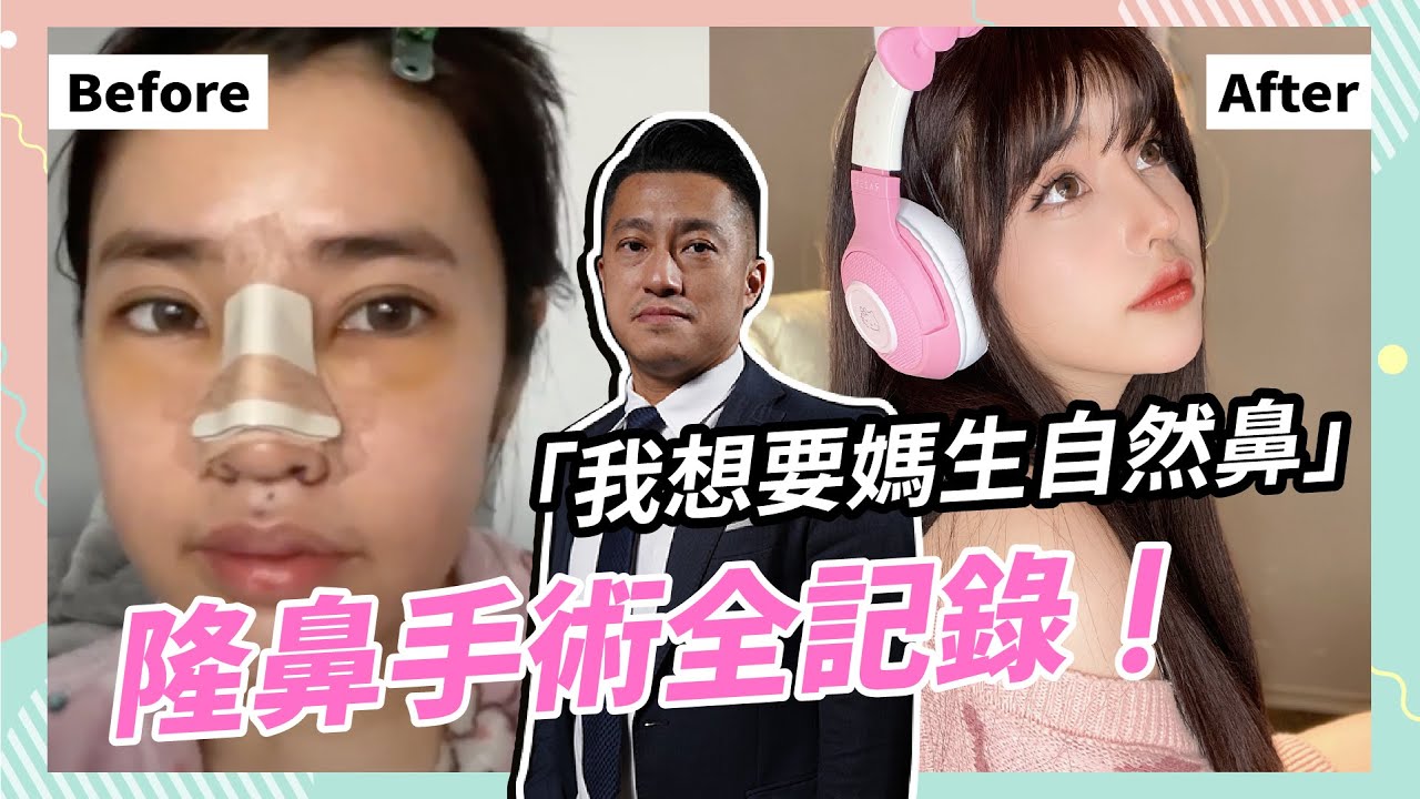 隆鼻90天全紀錄 牛鼻變身精靈翹鼻 Ria變精緻女孩的最後一哩路 【鼻子醫生 張簡】
