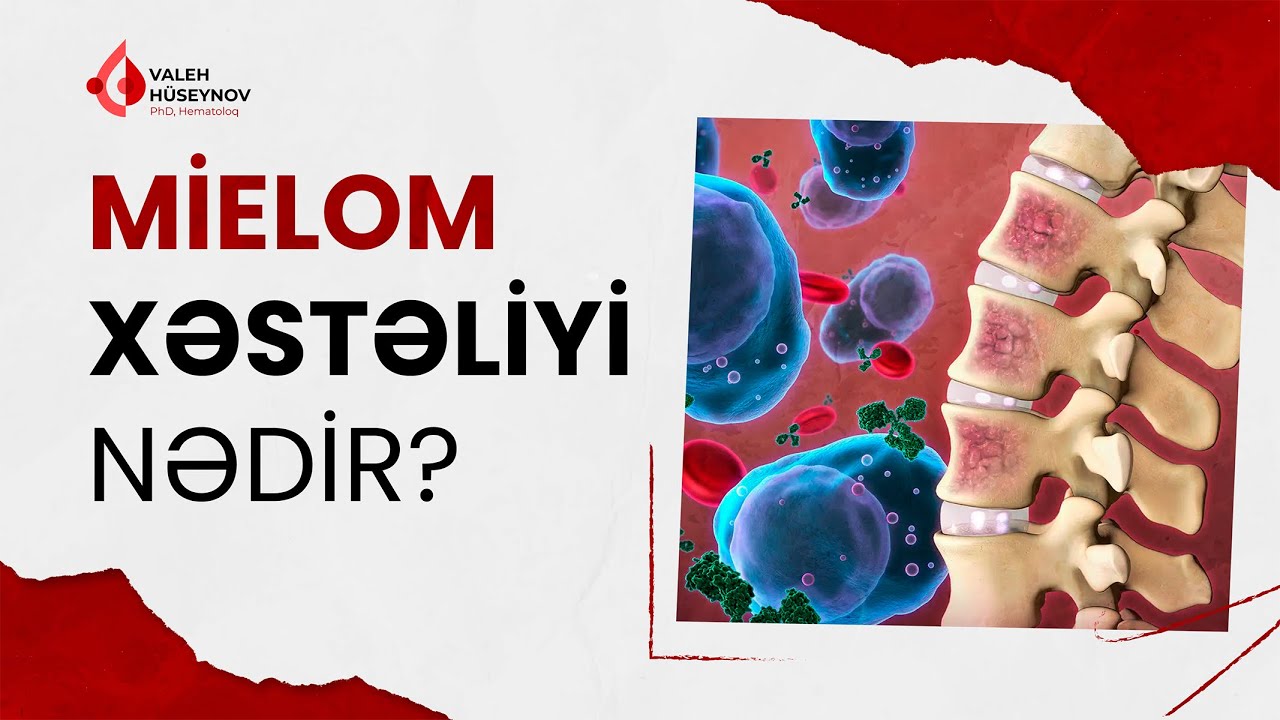 Mielom xəstəliyi nədir?