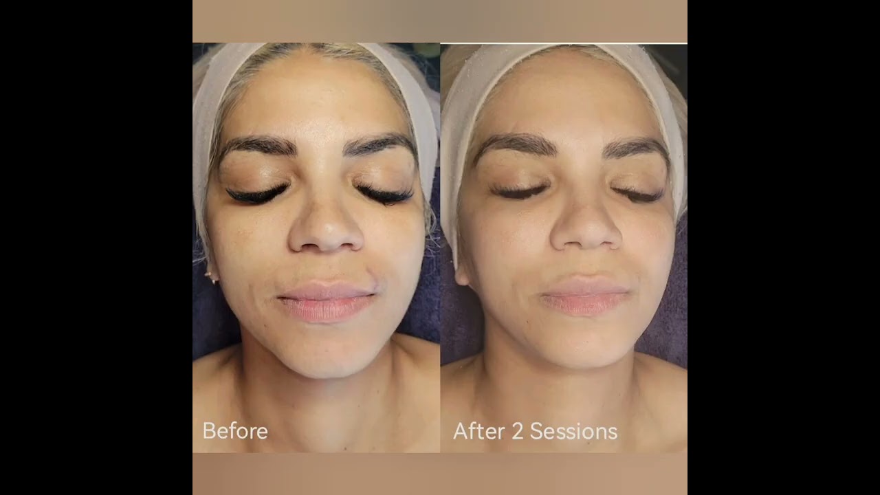 Bio-Microneedling Procedure