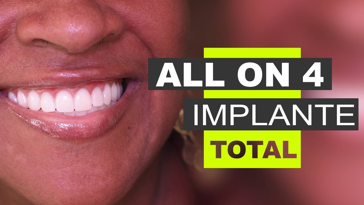 Implace Implantes - Protocolo All On 4