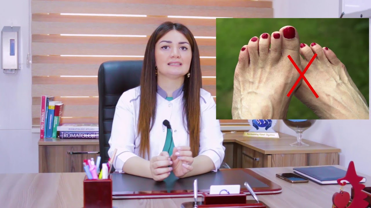 Podaqra.  Mütəxəssis Revmatoloq Dr.Günel Əsgərova