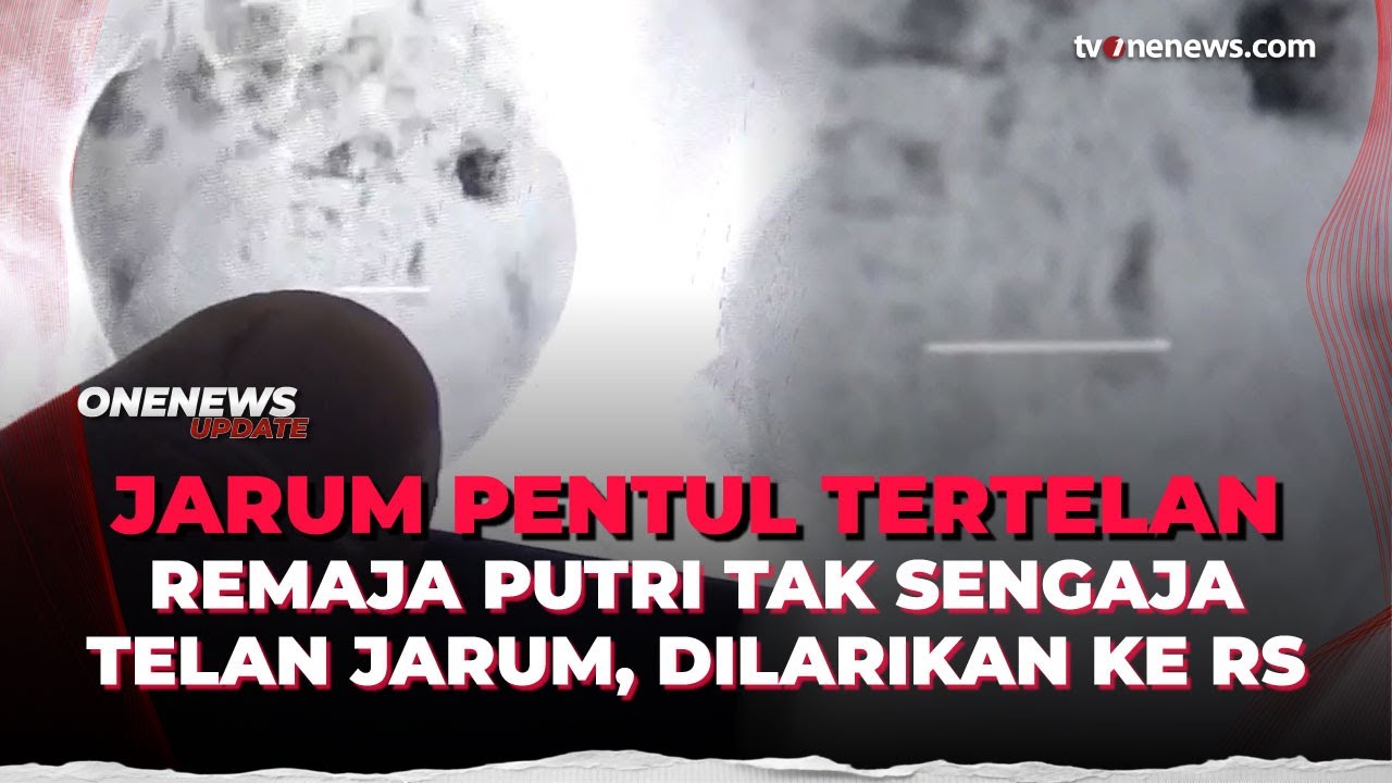 Akibat Simpan Jarum di Bibir, Remaja Putri di Sumedang Tak Sengaja Menelannya | OneNews Update