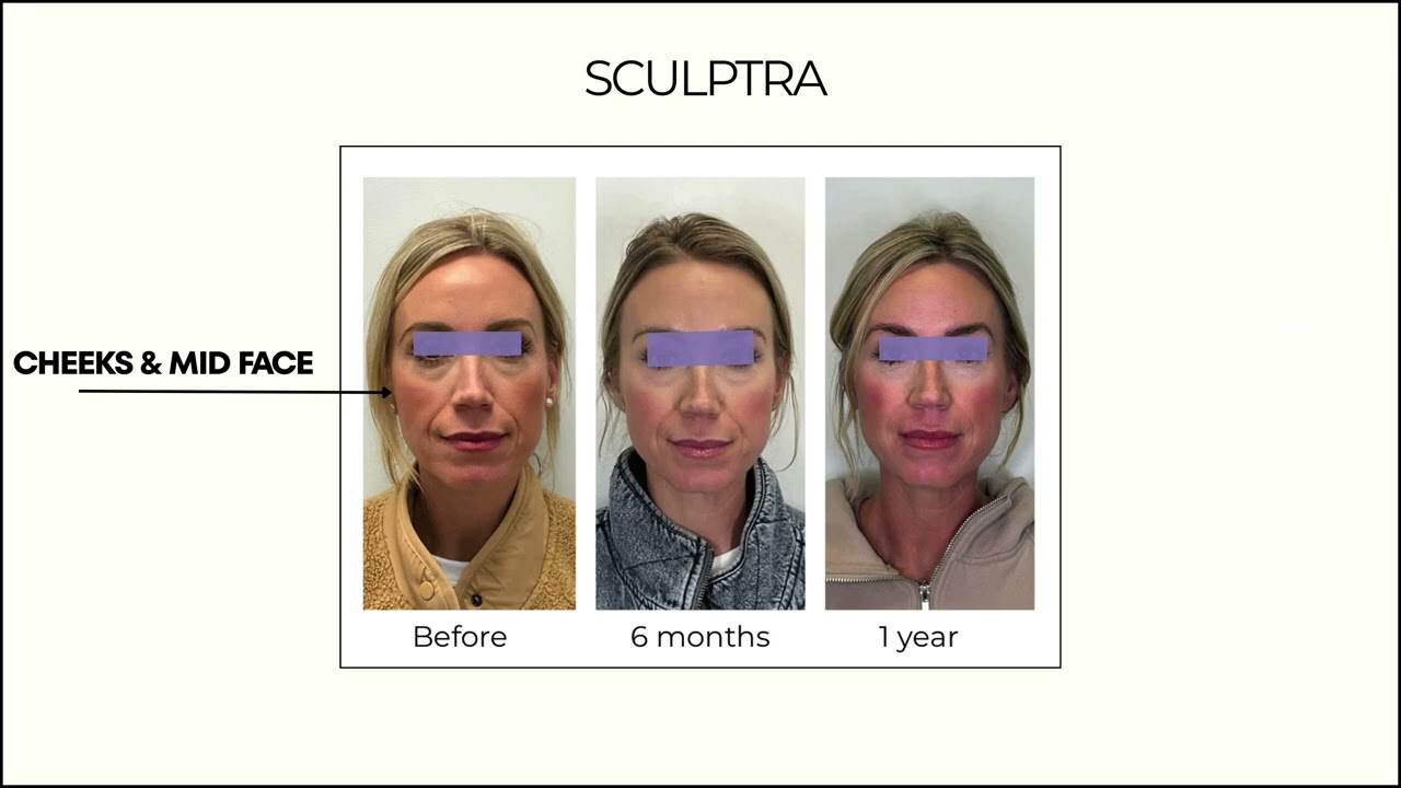 Sherman Oaks Medical Spa In office Treatment