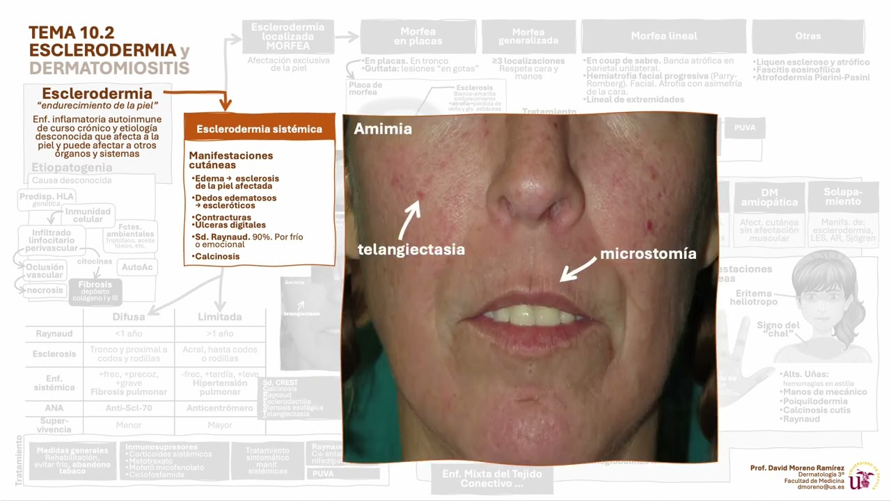 Tema 10.2. Esclerodermia y Dermatomiositis