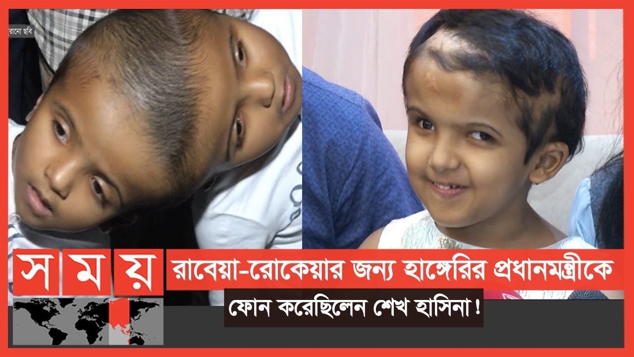 ৪৮ বার অপারেশন শেষে বাড়ি গেলো 'জোড়ামাথার' রাবেয়া-রোকেয়া ! | Conjoined Twins | Somoy TV