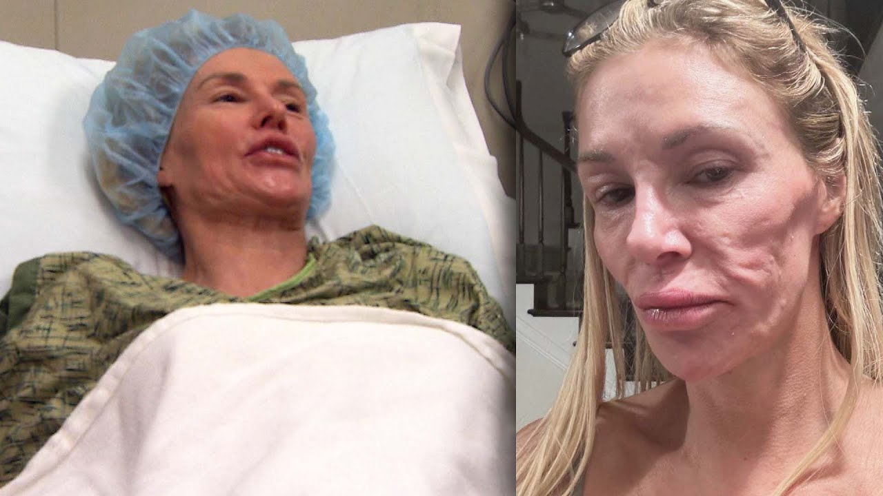 Inside Look At Reality Star Brandi Glanville's Life-Saving Surgery