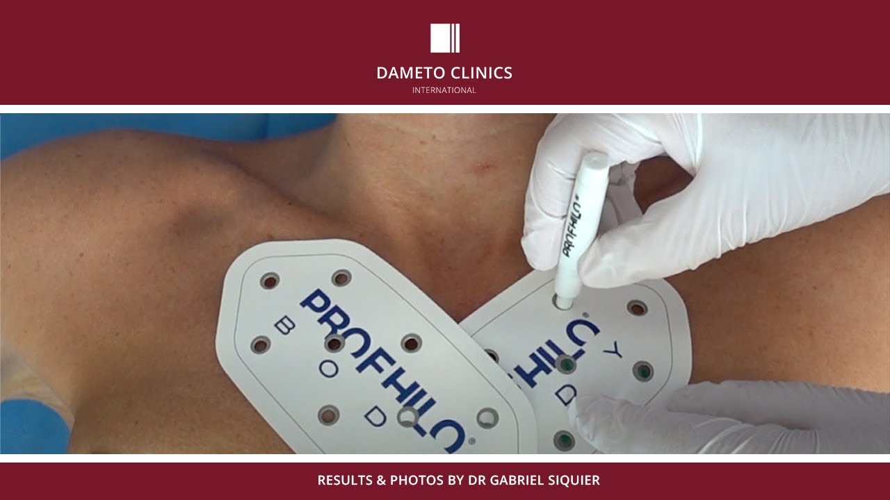 Profhilo Body 15 points decolleté technique by Dr. Gabriel Siquier