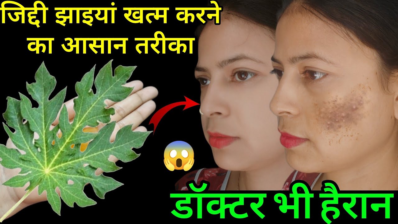 सिर्फ 7 दिनों में जिद्दी काली झाइयां जड़ से खत्म//Reduce Melasma, Pigmentation, Discolouration,