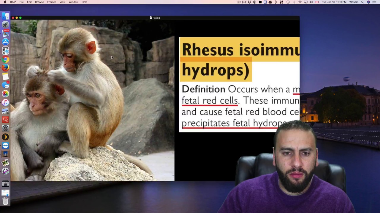 21- Rhesus Disease/ Isoimmunization / Alloimmunization