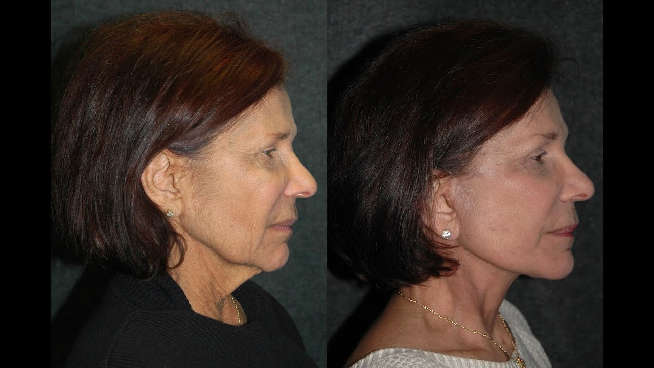 Local Anesthesia Facelift Without Surgery Anesthesia | Dr Jacono #facelift