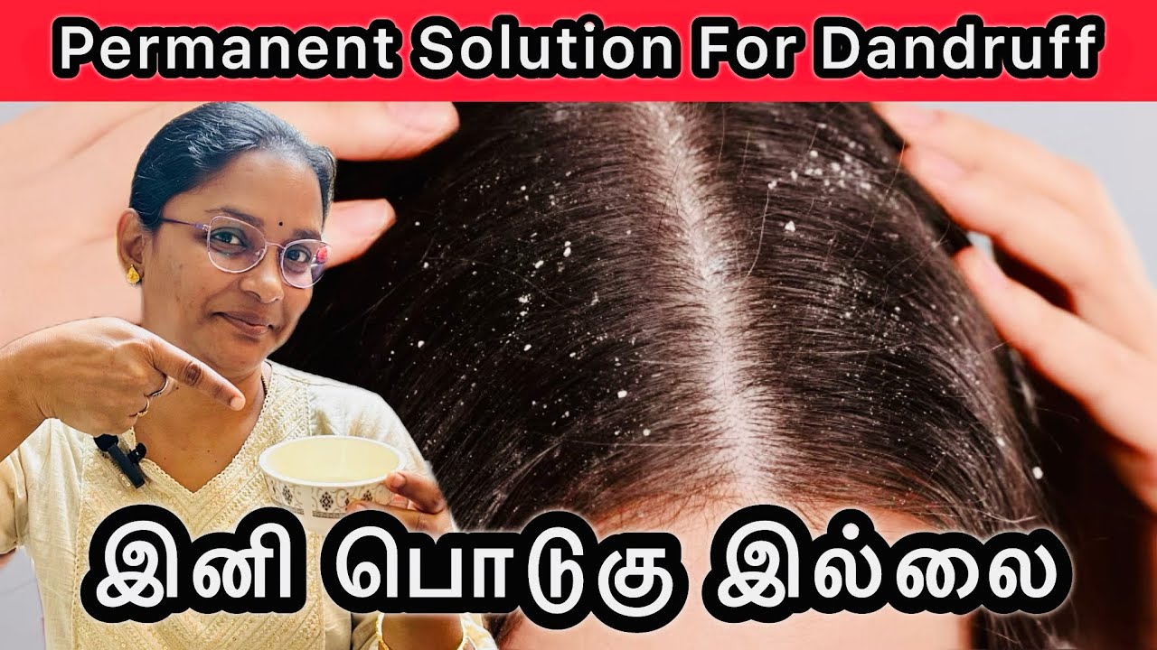 Permanent Solution For Dandruff 😃 இனி பொடுகு இல்லை #dandruff #dandruffcontrol #dandruffsolution 