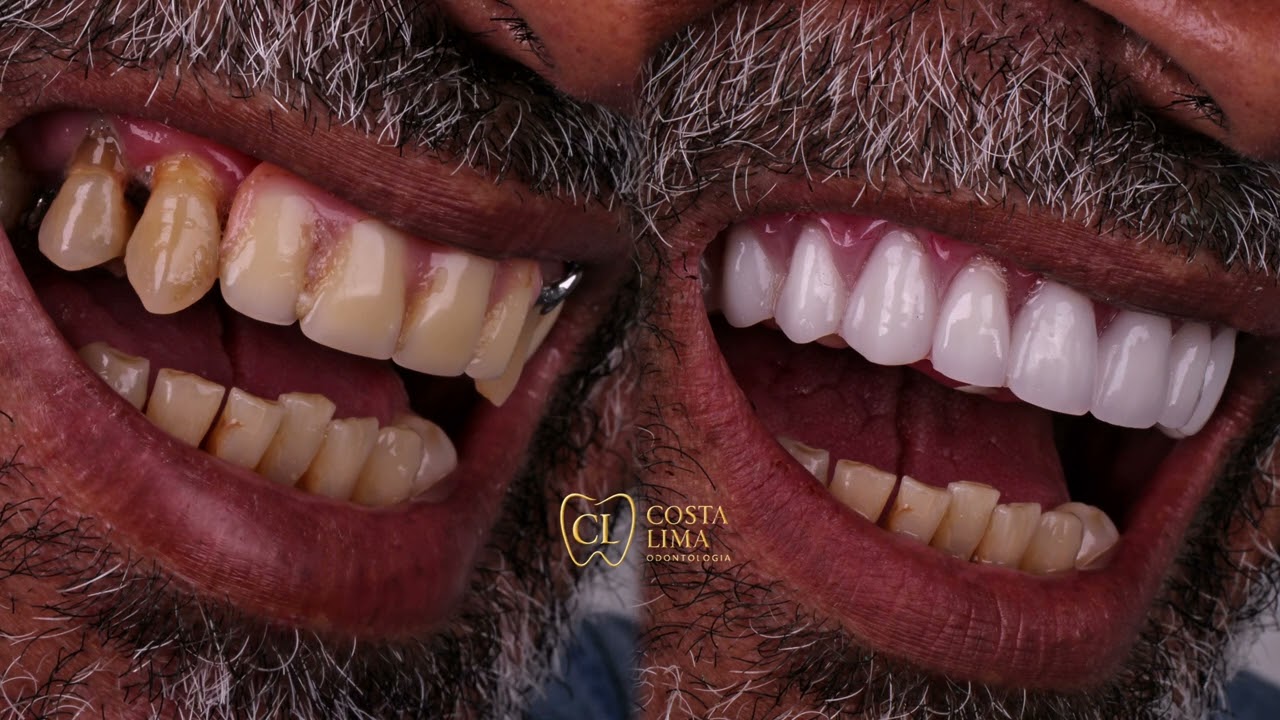 Prótese Protocolo: Veja o Antes e Depois do Sr. Ricardo com Dentes Fixos