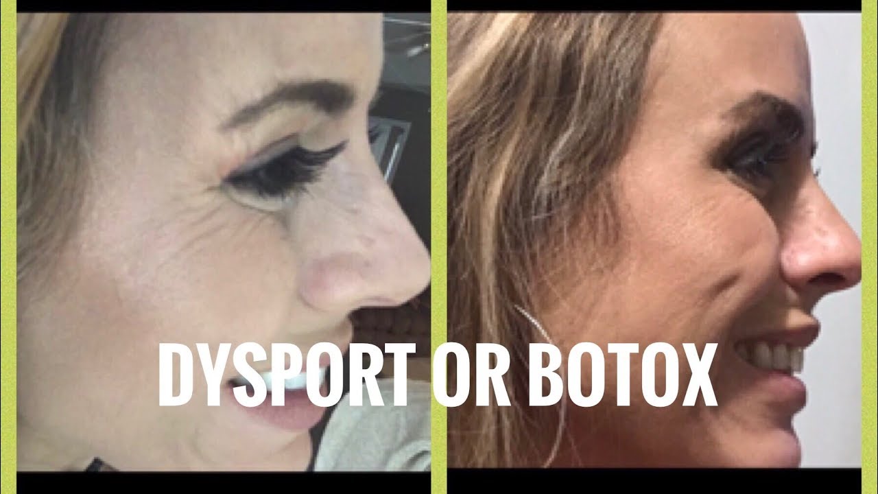 DYSPORT OR BOTOX??!!