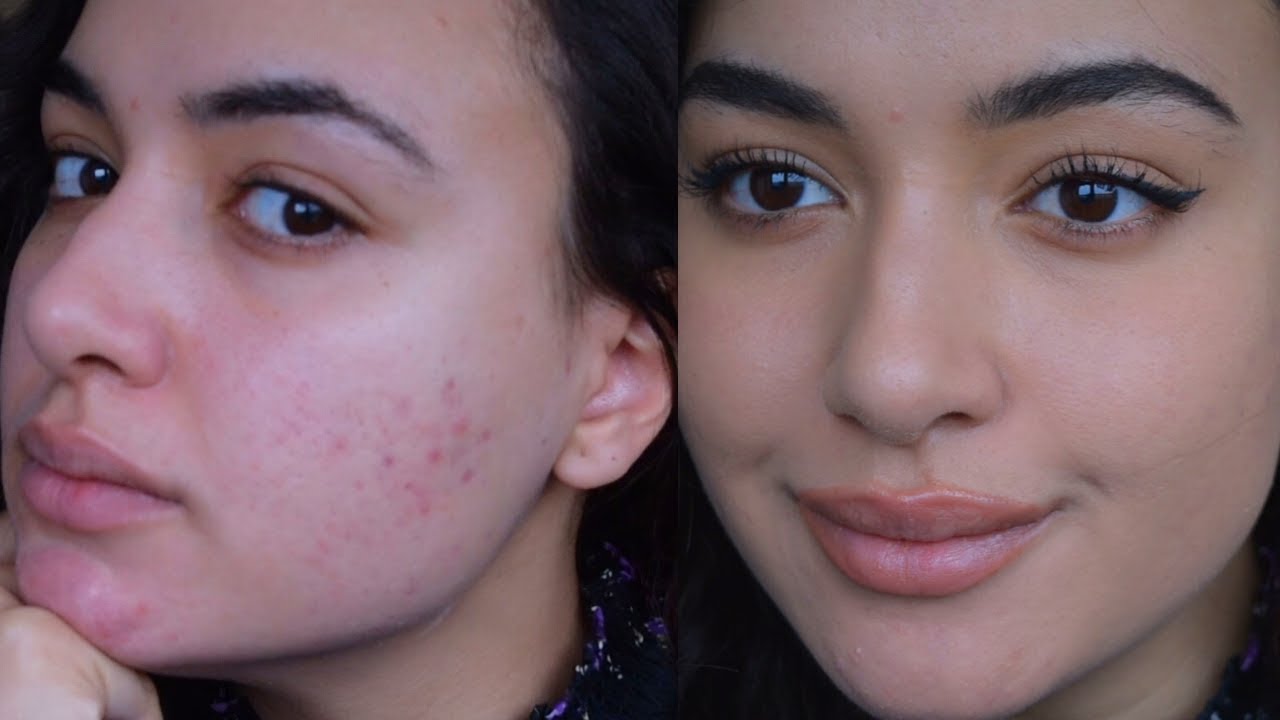 HOW TO LIGHTLY COVER ACNE MARKS WITH BAREMINERALS POWDER FOUNDATION| little coverage makeup acne