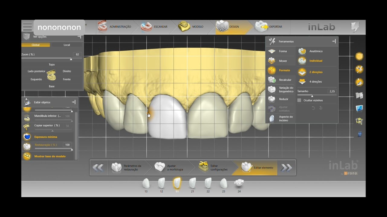 How we produce upper front dental veneers in less than 24 hours using CadCam Technology