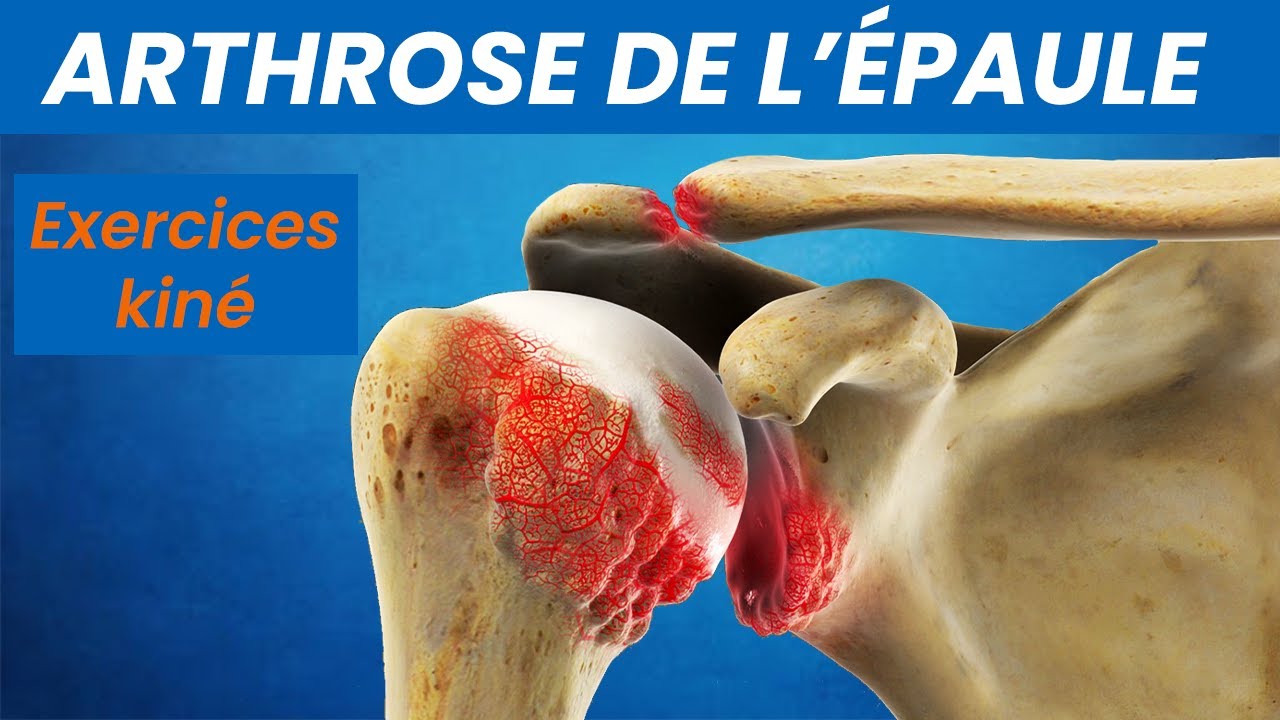 Soulager l' Arthrose de l'Epaule : Exercices kiné